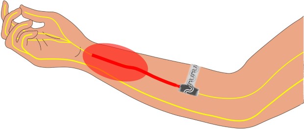 implant1